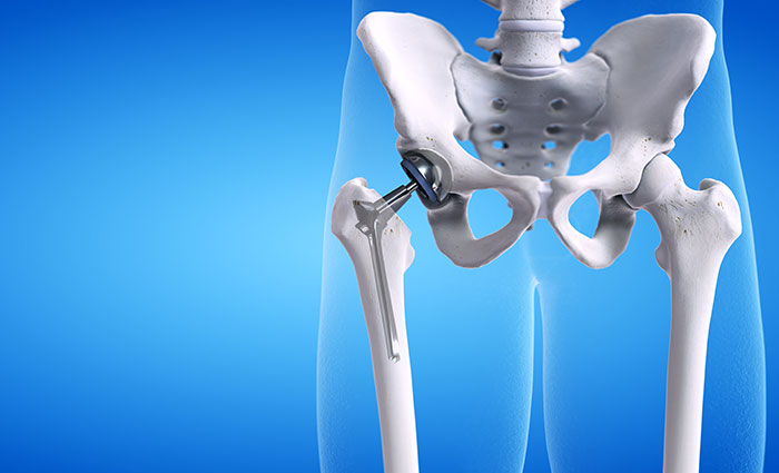 Hip Replacement