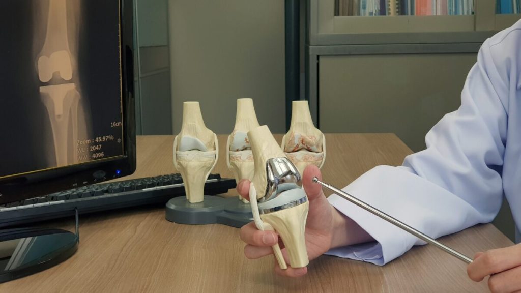 Knee Replacement