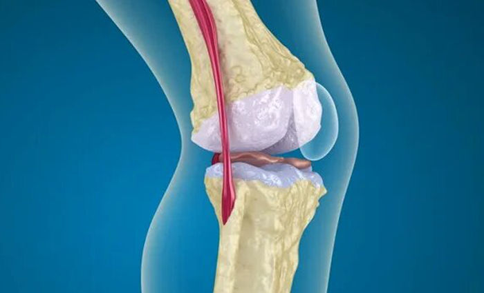 Osteoporosis