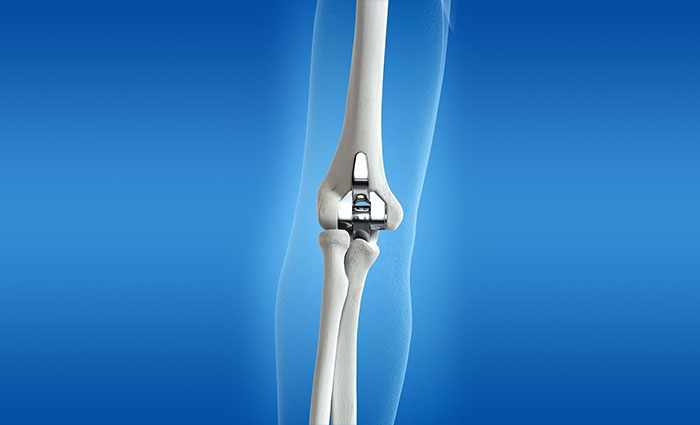 Elbow  Replacement