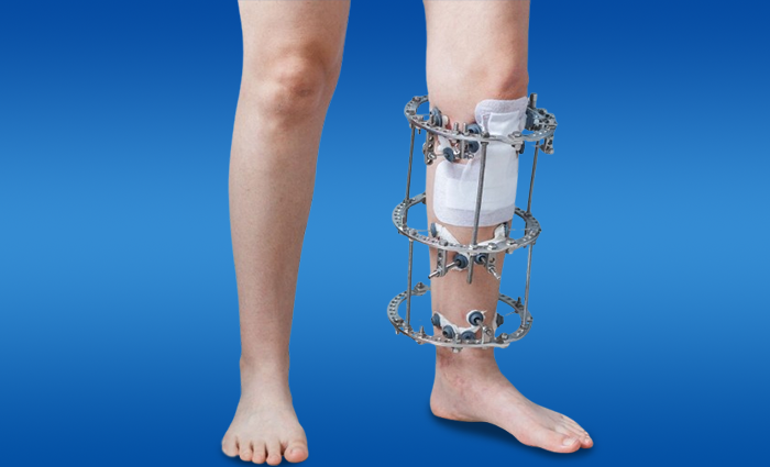 Ilizarov Fixation Treatment