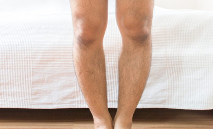 Rickets