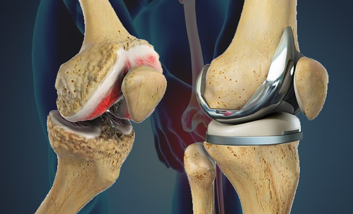 Joint Replacement
