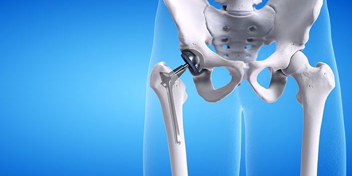 What-is-a-Total-Hip-Replacement